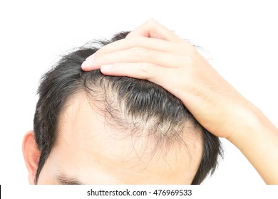 Receding Hairline Images Stock Photos Vectors Shutterstock