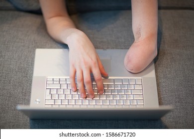 Close-up Of Young Woman With Amputee Arm Using Laptop Computer