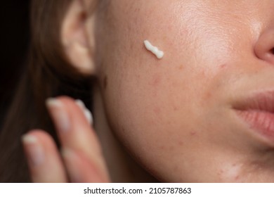 Closeup of a young woman applying prescription retinoid to her acne-prone skin with scarring and post-inflammatory erythema. - Powered by Shutterstock