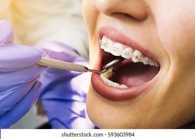 Closeup of young woman with braces dental checkup 