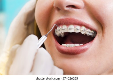Closeup young woman checking her braces, smiling - Shutterstock ID 574026265