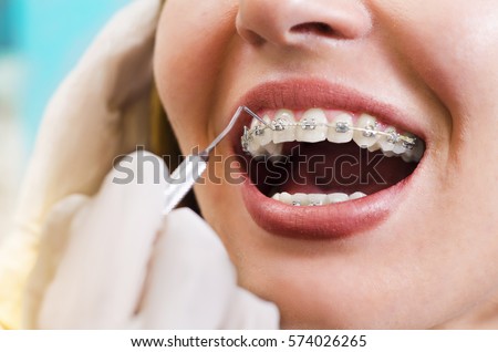 Closeup young woman checking her braces, smiling ストックフォト © 