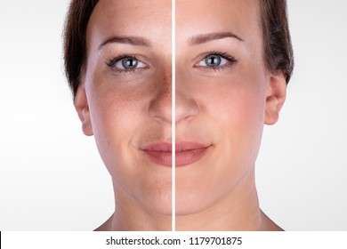 Close-up Of A Young Woman's Face Before And After Cosmetic Procedure
