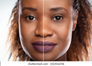 Close-up Of A Young Woman's Face Before And After Cosmetic Procedure