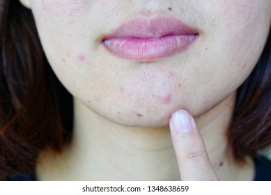 Closeup Of Young Woman's Face For See Problem Skin (acne, Pimple, Rash, Pore And Blotch), Beauty Concept