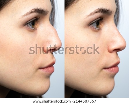 Closeup of a young woman's nose before and after nasal filler surgery. Rhinoplasty without surgery but with temporary injections of hyaluronic acid based fillers.