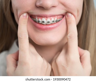 Close-up of a young woman's smile with metal braces on her teeth. Correction of bite
