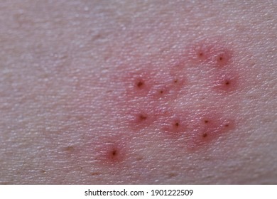 Close-up, zoom image Shingles, Zoster or Herpes Zoster symptoms on skin,Wound is healed and starts to dry out