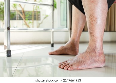 Closeup,Asian old senior with swollen feet,pain or numbness in the ankle,leg vein thrombosis,varicose veins problem,elderly people having diabetes,kidney or liver disease,edema or swelling in the feet