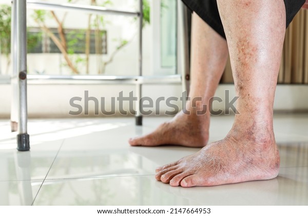 Closeup,Asian old senior with swollen feet,pain or\
numbness in the ankle,leg vein thrombosis,varicose veins\
problem,elderly people having diabetes,kidney or liver\
disease,edema or swelling in the\
feet