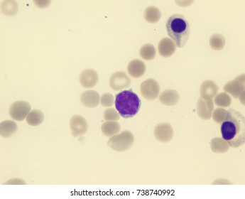 Clostridium Perfringens Sepsis 