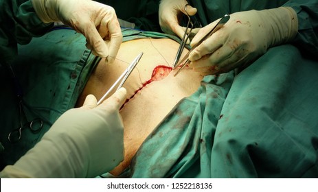 Closure of Mastectomy Skin Incision with Subcuticular Method.