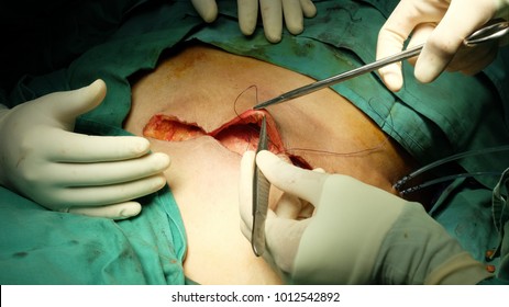 Closure of Mastectomy Wound step by step procedures performed by surgeon.