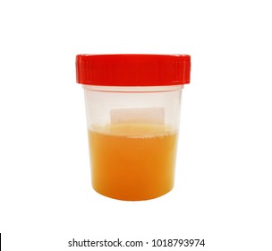 Cloudy Or Bloody Urine Sample In Sterile Plastic Container Isolated On White Background With Clipping Path, Cloudy Or Bloody Urine Is A Symptom Of Urinary Infection Determined By Urine Dipstick Test.