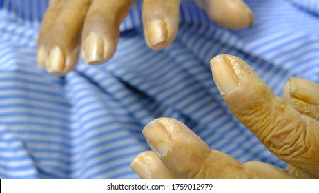 Clubbing Of Fingers In Patient With Chronic Airway Disease.