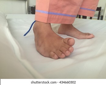 Clubfoot Images Stock Photos Vectors Shutterstock