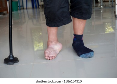 Clubfoot High Res Stock Images Shutterstock