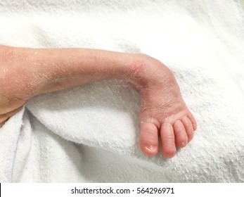 Clubfoot In Newborn