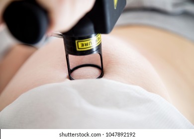 Co2 Laser Resurfacing Treatment For Belly. Abdominal Rejuvenation.