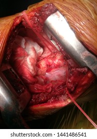 Coarctation Of Descending Aorta (CoA)