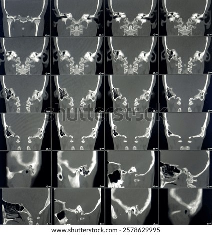 The  cochlea and semicircular canals appear normal. Theke right  mastoid air cells appear well pneumatized and left mastoid air cells not well pneumatized.