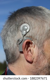 Cochlear Implant Close Up, Therapy, Hearing