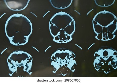 Coconut Shell On Black X-ray Film