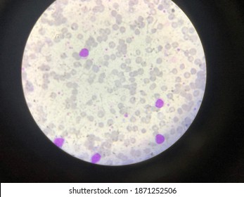 Cold Agglutination Of Red Blood Cells From B Cell Lymphoma.