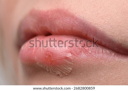 Cold sore patch, red pimple on woman's lips close up