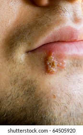 Cold Sores (herpes Labialis)