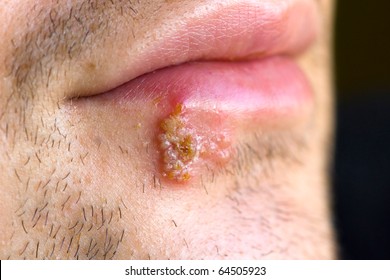 Cold Sores (herpes Labialis)