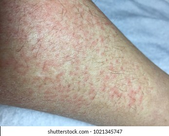 Cold Urticaria Allergic On Leg Background 1021345747 Shutterstock   Cold Urticaria Allergic On Leg 260nw 1021345747 