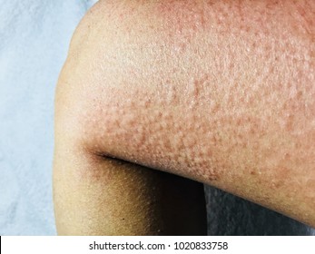 Cold Urticaria Allergic On Legs In Winter