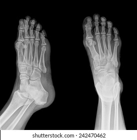 2,535 Broken foot xray Images, Stock Photos & Vectors | Shutterstock