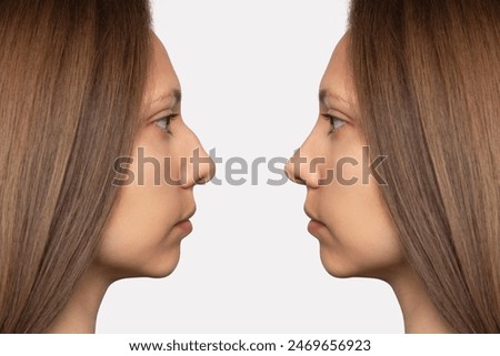 Collage before and after plastic surgery on the nose, isolated on a white background. Woman's face in profile. Correction of the nasal septum, rhinoplasty, septoplasty. Straightening the hump