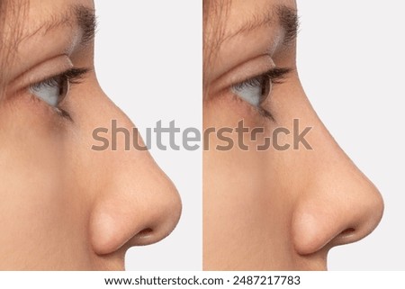 Collage before and after plastic surgery on the nose, isolated on a white background. Woman's face in profile. Correction of the nasal septum, rhinoplasty, septoplasty. Straightening the hump