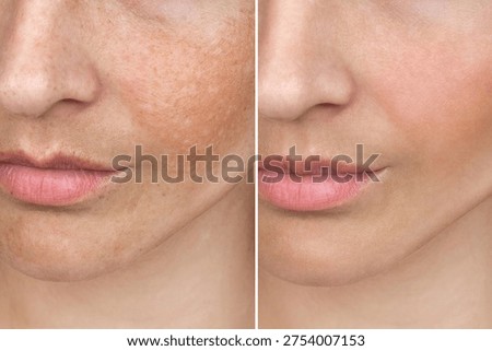 Collage before and after procedure removing pigment from the skin, use cream, LPL, caucasian woman face with freckles or age spots on the face