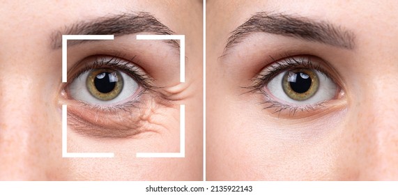 Collage from closeup views of women eyes. Comparison of before and after beauty care intervention of wrinkles, crow's feet and dark circles under eyes removal