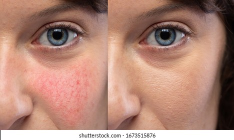 Collage comparing healthy skin and face suffering rosacea, visible blood vessels and capillaries. Caucasian woman face closeup. Medicine and healthcare concept.
