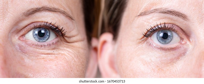 Collage comparison before and after beauty care for removing crow's feet. Closeup view of aged women eyes. 
