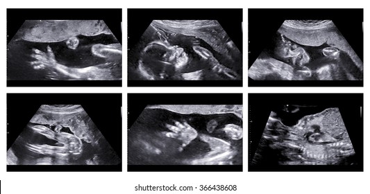 Collage of medical images of ultrasound anomaly scan on a female fetus 20 weeks into the pregnancy, showing child's hand, head, feet, legs, spine and position inside womb