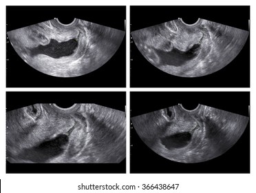 Collage Of Medical Images Of Ultrasound During Anomaly Scan Showing Cervical Incompetence (insufficient Cervix) In U Shape, Reason For Hospitalization Of Pregnant Women; Dangerous Medical Condition