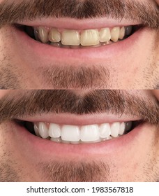 Collage With Photos Of Man Before And After Teeth Whitening, Closeup
