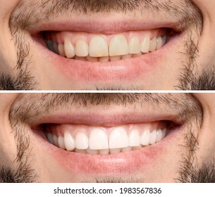Collage With Photos Of Man Before And After Teeth Whitening, Closeup