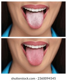 Collage with photos of woman before and after tongue cleaning, closeup