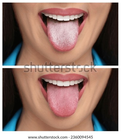 Collage with photos of woman before and after tongue cleaning, closeup