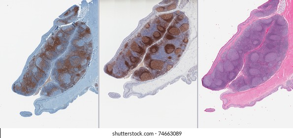 Collage Of Three Images Of Tonsils Stained For B Lymphocyte, T Lymphocyte, And Routine Stain (HE).