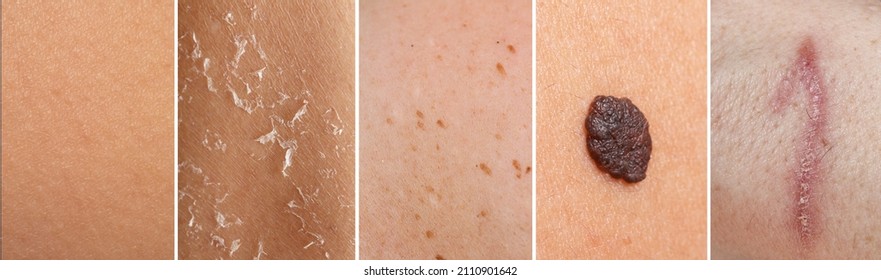 Collage Of Various Rectangles Of Human Skin With Different Issues. Composition With Normal, Dry, Blemished And Scarred Skin And Skin With A Mole