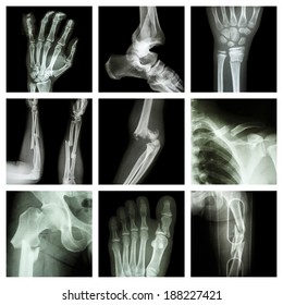 Collection Bone Fracture Stock Photo (Edit Now) 188720630