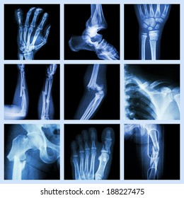 Collection Of Bone Fracture